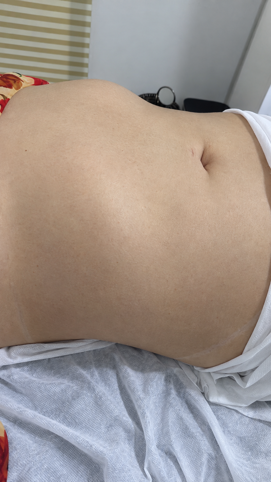 Abdômen depois das sessões de massagem modeladora na Clínica PIO